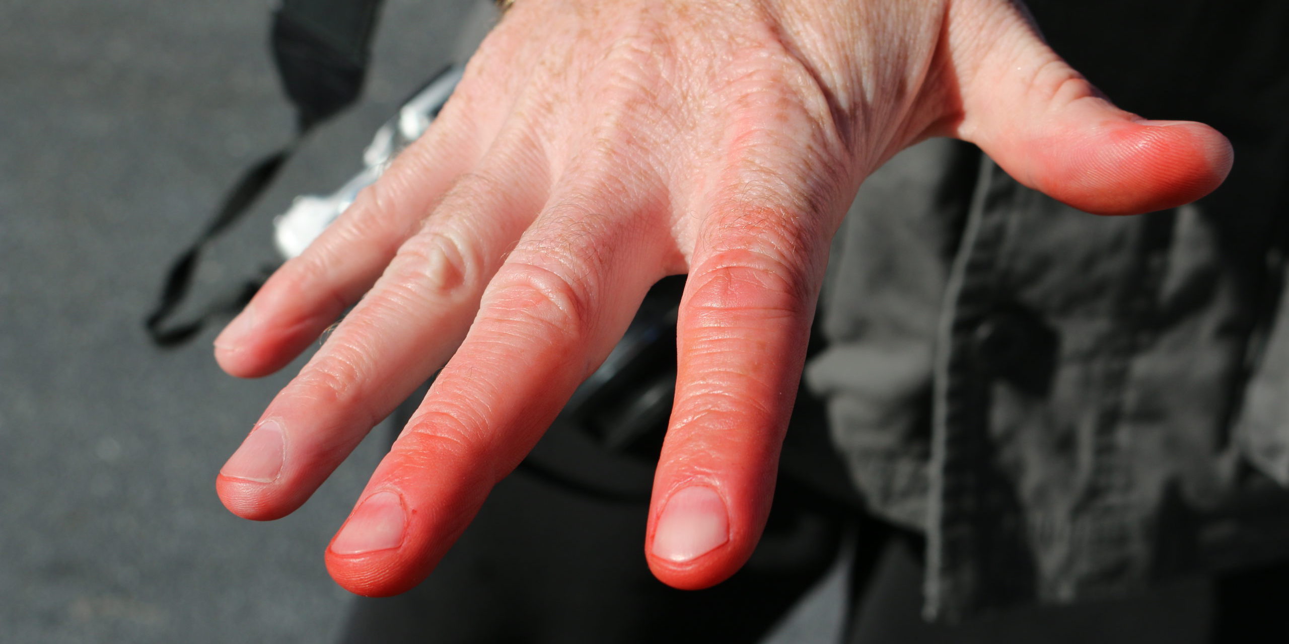 Frostbite 101: An RV Winter Survival Guide